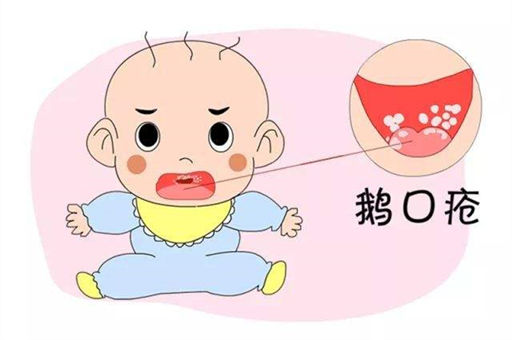 新生儿鹅口疮的原因和症状表现