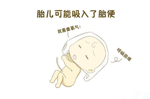 小心预防胎粪吸入综合征