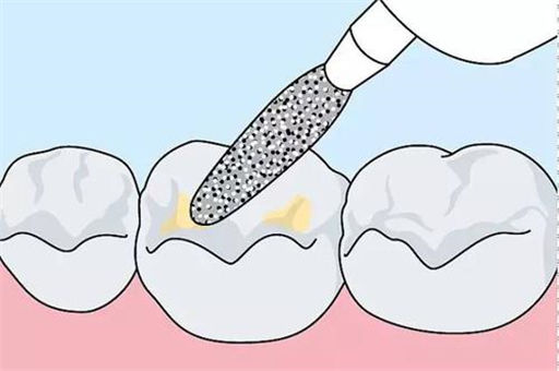 孩子有必要做窝沟封闭吗？几岁做合适？