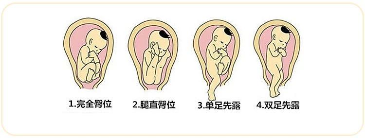 米诺娃妇女儿童医院婴儿臀位有哪几种