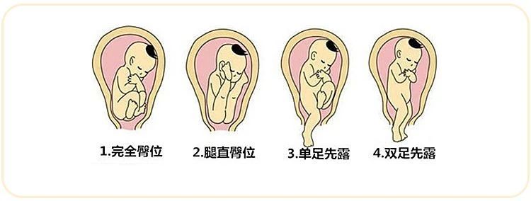 胎儿臀位有哪些