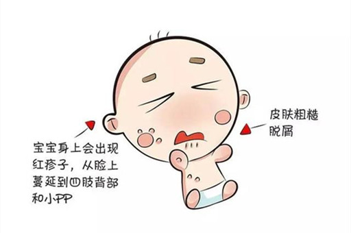 宝宝湿疹怎么办？宝宝湿疹怎么护理？