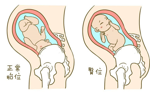 什么是胎儿臀位？胎儿臀位的危害有哪些？