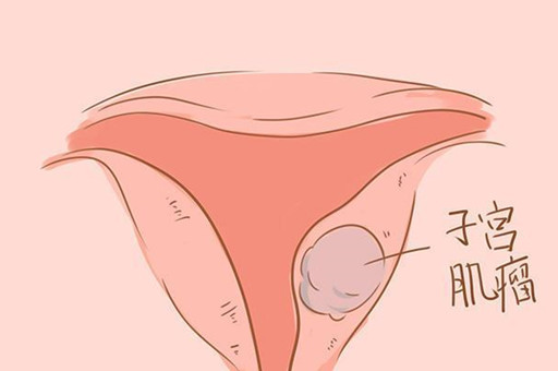 子宫肌瘤对怀孕有影响吗？