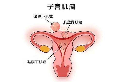 米诺娃妇女儿童医院：子宫肌瘤会影响怀孕吗？