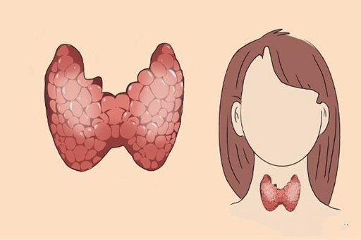 引起桥本甲状腺炎的3大因素