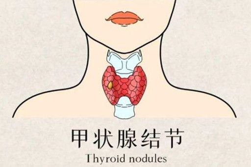 四川甲状腺医院：甲状腺结节注意事项有哪些